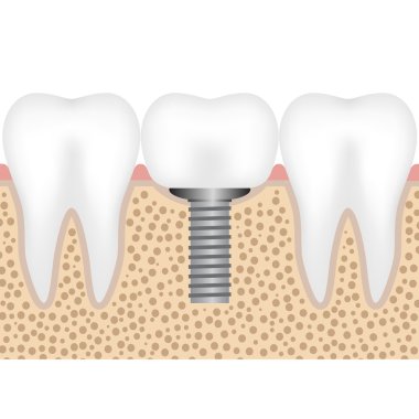 Dental implant with crown clipart
