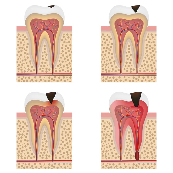 Sviluppo dell'illustrazione della carie dentale . — Vettoriale Stock