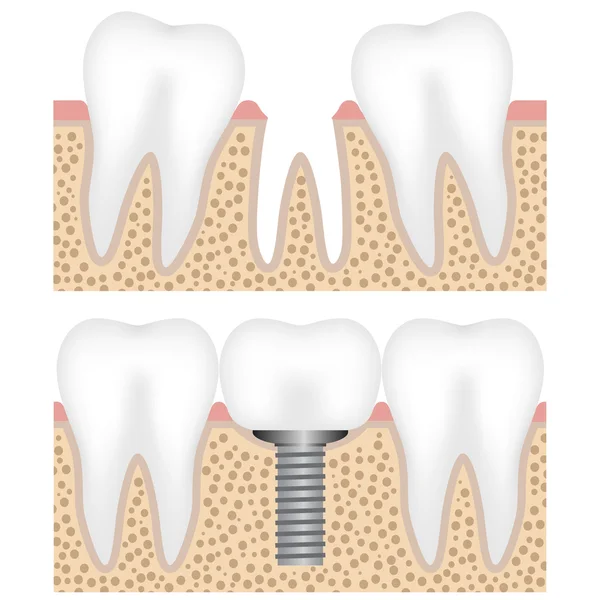 Dental implant with crown — Stock Vector