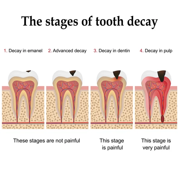 Formación de caries dental Ilustraciones de stock libres de derechos