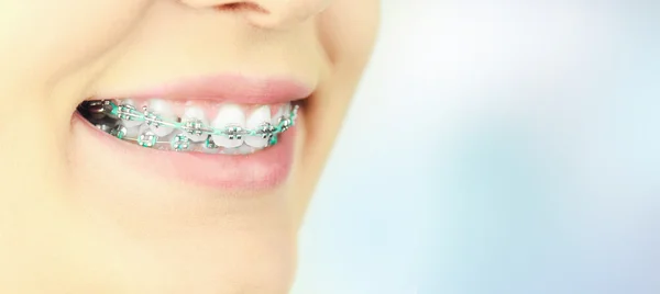 Skönhet kvinna leende med ortodontic tillbehör. Ortodonti behandling. — Stockfoto