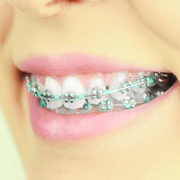 Mujer belleza sonrisa con accesorios de ortodoncia. Tratamiento de ortodoncia . —  Fotos de Stock