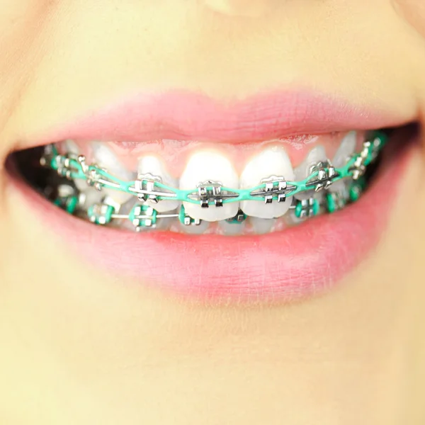 Beauty woman smile with ortodontic accessories. Orthodontics treatment. — Stock Photo, Image