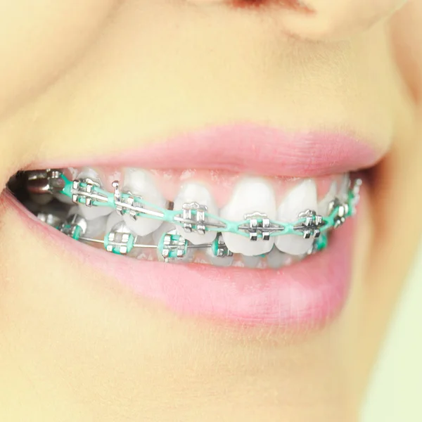 Mujer belleza sonrisa con accesorios de ortodoncia. Tratamiento de ortodoncia . — Foto de Stock