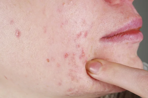 Pele com os problemas de acne — Fotografia de Stock