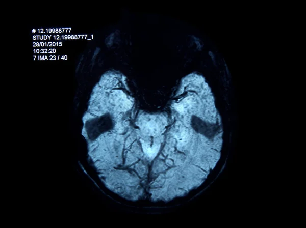 Escaneamento de Mri — Fotografia de Stock