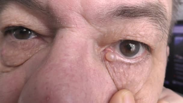 Idrocistoma Apocrate Della Palpebra Questa Una Cisti Benigna Della Ghiandola — Video Stock