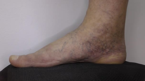 Krampfadern Männlichen Fuß Form Von Besenreiser — Stockvideo