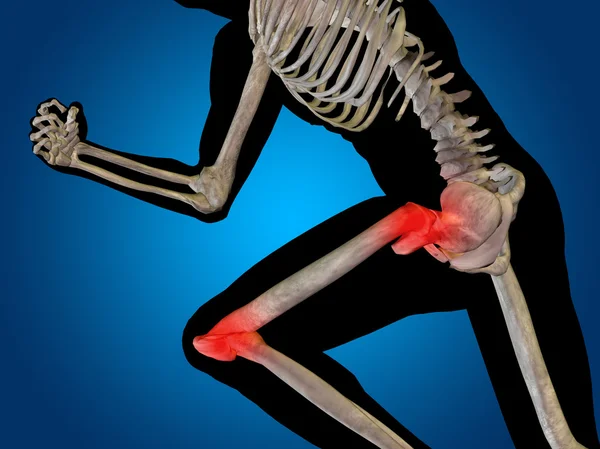 Dolor articular en las articulaciones — Foto de Stock