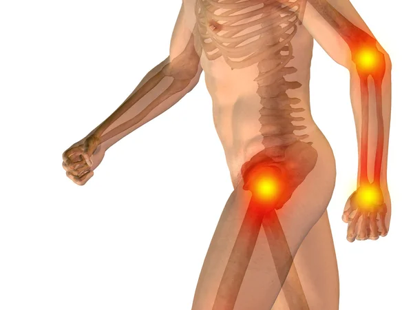 ortak veya eklem ağrısı, ağrı