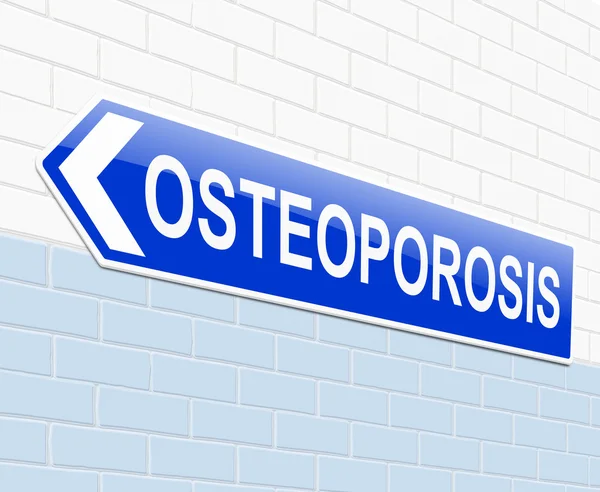 Concetto di osteoporosi . — Foto Stock