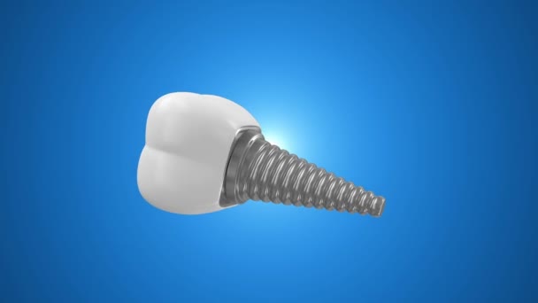 Tooth Implant — Stock Video