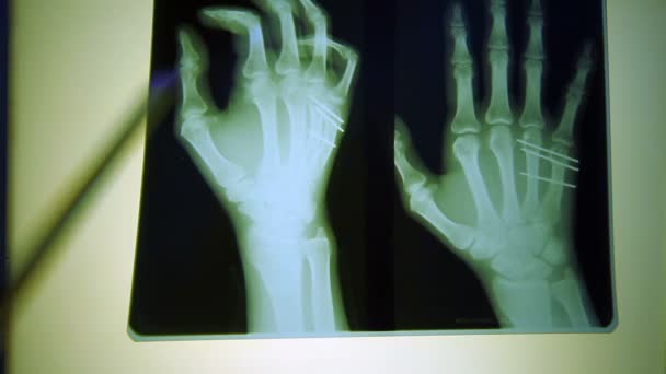 Mänskligt finger scan, tech medicinska X-ray scanning — Stockvideo