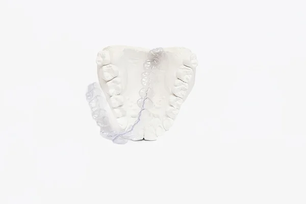 Zbliżenie poszczególnych zębów taca ortodontyczne zębów tematu. Aparaty lingwalne — Zdjęcie stockowe