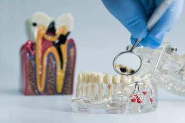 Şiddetli diş çürümesini gösteren bir diş modelinin yakın çekimi, eğitim veya tıbbi gösterim amacıyla ayna ile incelenmiştir..