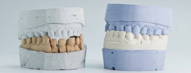 Two sets of dental plaster jaw models used for orthodontic and prosthodontic planning, showing upper and lower teeth alignment.