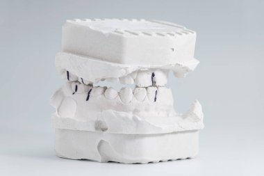 Detailed plaster dental model showing occlusal contact points used for bite analysis in orthodontic and prosthetic dentistry.
