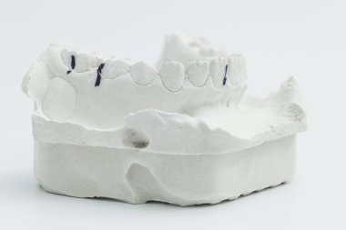 Close-up of a lower jaw dental cast showing occlusal ink markings used for bite adjustment and prosthetic dental planning.