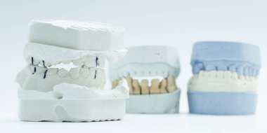 Ortodonti teşhisinde ve ısırık ayarlamasında kullanılan tıkanma işaretleri olan beyaz alçı diş kalıbının yakın çekimi..