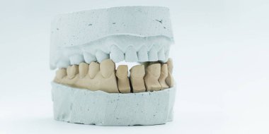 Diş kalıbının yakın çekimi, alt dişler taçlara hazır, protodontik planlama ve diş yenileme çalışmalarında kullanılıyor..