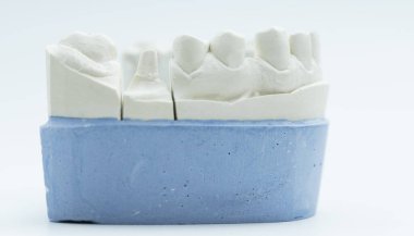 Bir kaplama diş modelinin yakın plan portresi, protodontikteki restoratif planlama için tek diş ile hazırlanır..