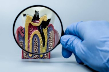 Çürümüş bir dişin detaylı anatomik modeli, eldivenli bir el tarafından tutulan bir büyüteç, çürüklerin altını çizmek, kök hasarı ve eğitim veya teşhis amaçlı oral sağlık sorunları yoluyla incelenir..