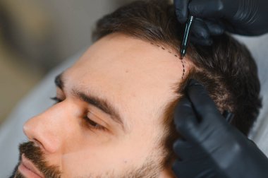 Foliküler ünite çıkartma için erkek hastanın kafa derisinde profesyonel saç ekimi çizimi - fue - yöntemi