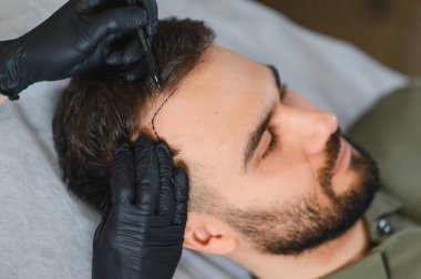Hasta saç yenileme prosedürü için hazırlanıyor. Saç foliküler implantasyonu için kafa derisini işaretleyen uzman.