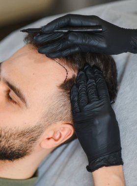 Eldivenli doktor elleri, bir klinikte saç nakli prosedürüne hazırlanırken erkek hastanın kafa derisine işaret çizgisi çiziyor.