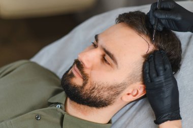 Bir klinikte saç dökülmesi tedavisi gören genç bir adam ve kafasına ameliyat için çizgiler çizen bir doktor.