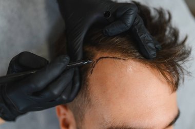 Erkek bir hastanın kafasında saç nakli prosedürüne hazırlanan bir saç çizgisinin çekildiğini gösteren sağlık uzmanları.