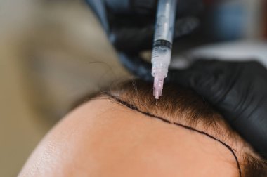 Uzman bir trikoloji kliniğinde saç dökülmesi tedavisi için kafa derisine mezoterapi yapılan hasta