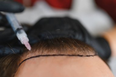 Doktor, müşterinin kafa derisine anestezi enjekte ediyor. Saç ekimi ameliyatına hazırlanıyor. Saçların uzaması ve kelliğin tedavisi için.