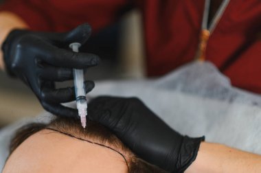 Siyah eldivenli trikoloğum saç dökülmesi tedavisi için işaretlenmiş bir hastanın kafa derisine mezoterapi yapıyor.