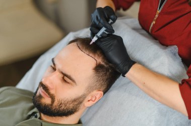 Klinikte saç dökülmesini önlemek için mezoterapi yapılan kafa derisi enjeksiyonu ve uzman doktor tarafından yeniden büyümenin uyarılması