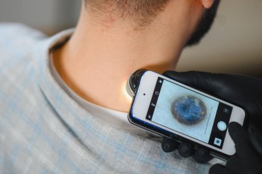 Doktor, akıllı telefon eklenmesiyle hastanın boynundaki beni inceliyor. Melanom ve deri kanseri belirtilerini kontrol ediyor.