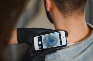 Dermoskopi, melanom ve deri sorunları için özel bir akıllı telefon eklentisi kullanarak hastanın deri benini inceleyen doktor.