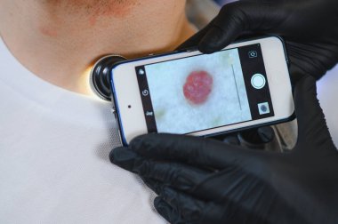 Dermatolog, cilt kanseri taraması için akıllı telefona bağlı bir dermatoskopla hastanın boynundaki beni inceliyor.