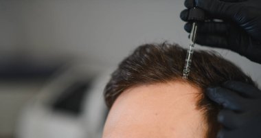 Profesyonel el, saç dökülmesini ve trikolojiyi ele alan bir adamın kafa derisine damlatan bir tedavi serumu uyguluyor.