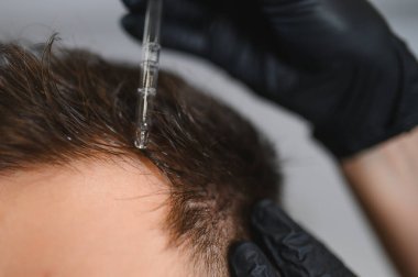 Siyah eldiven giyen profesyonel trikoloğum hastanın saç dökülmesini tedavi ediyor, büyümeyi hızlandırmak için pipetli bir serum uyguluyor.