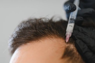 Saç kaybı ve yeniden büyüme tedavisi için kafa derisi enjeksiyonu yapılan hasta. Dermatoloji işlemi sırasında şırınga kullanan bir tıp uzmanı.