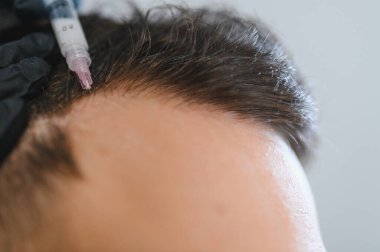 Saç incelmesi ve kelleşmesini tedavi etmek için şırınga ve iğne kullanan profesyonel bir cerrah.