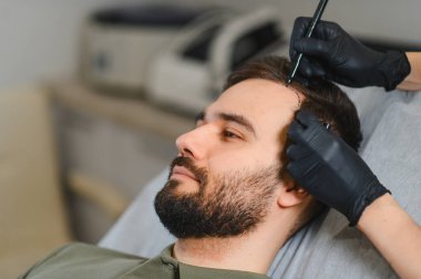 Bir klinikte saç nakli prosedürü için erkek hastanın kafa derisini işaretleyen doktor saç kaybı ve kellik sorunlarını ele alıyor.