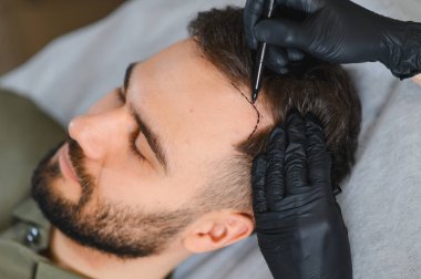 Adam yerde yatarken tıpta saç ekimi için saç çizgisi çiziyor. Saç dökülmesi tedavisi, kellik tedavisi