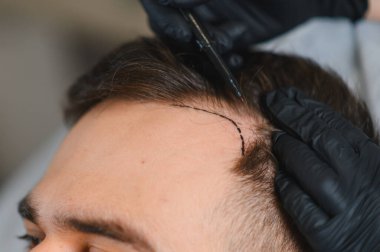 Folikül ünitesinin çıkarılması için yeni saç çizgisini belirleyen bir uzmanla birlikte hastanın saçının yenilenme prosedürü devam ediyor.