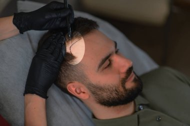 Eldivenli cerrahların elleri, saç ekimi çözümüne hazırlanan bir adamın kafa derisinde yeni bir saç çizgisini gösteriyor.