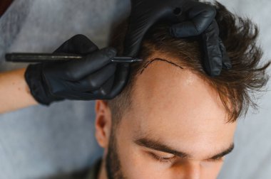 Trikoloğum genç bir adamın kafa derisine saç nakli ameliyatı için saç çizgisi çiziyor. Saç dökülmesi tedavisi ve restorasyon