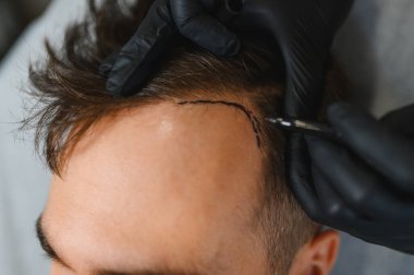 Cerrah, erkek bir hastanın kafasında kellik tedavi bölgesini işaretliyor. İşlem için saç nakli bölgesini özetliyor.