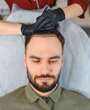 Hasta saç nakli için hazırlanıyor, bir doktor gelecek cerrahi işlem için kafasındaki saç çizgisini işaretliyor.