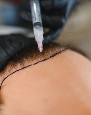 Hasta saç dökülmesi için kafa derisi iğnesi yaptırıyor. Mezoterapi prosedürünü bir trikoloğa yaptırıyor.